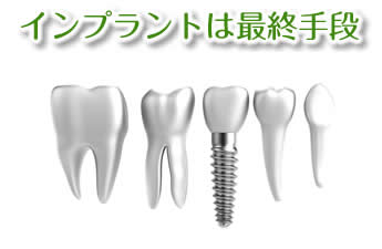 インプラントは最終手段